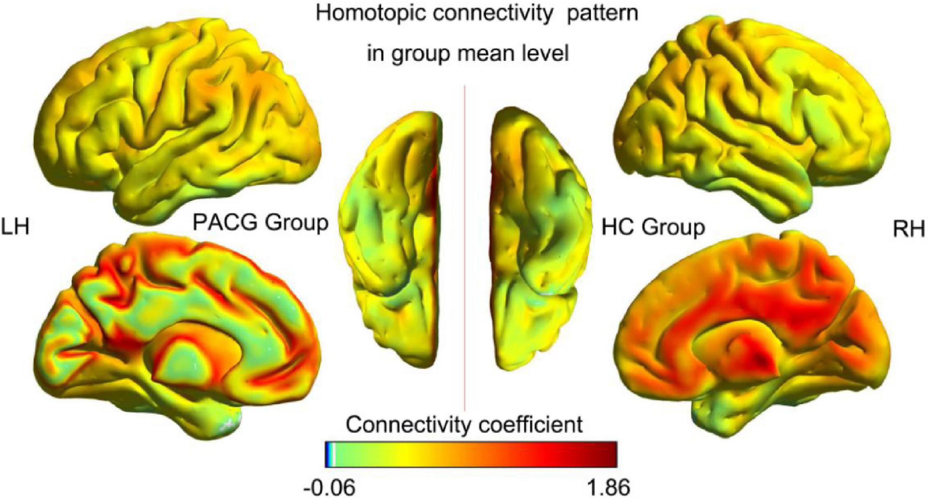 Effects of primary angle-closure glaucoma on interhemispheric functional connectivity